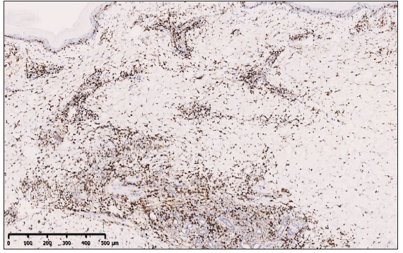 The proliferative index (ki-67) was exceedingly high (80%) (100x).